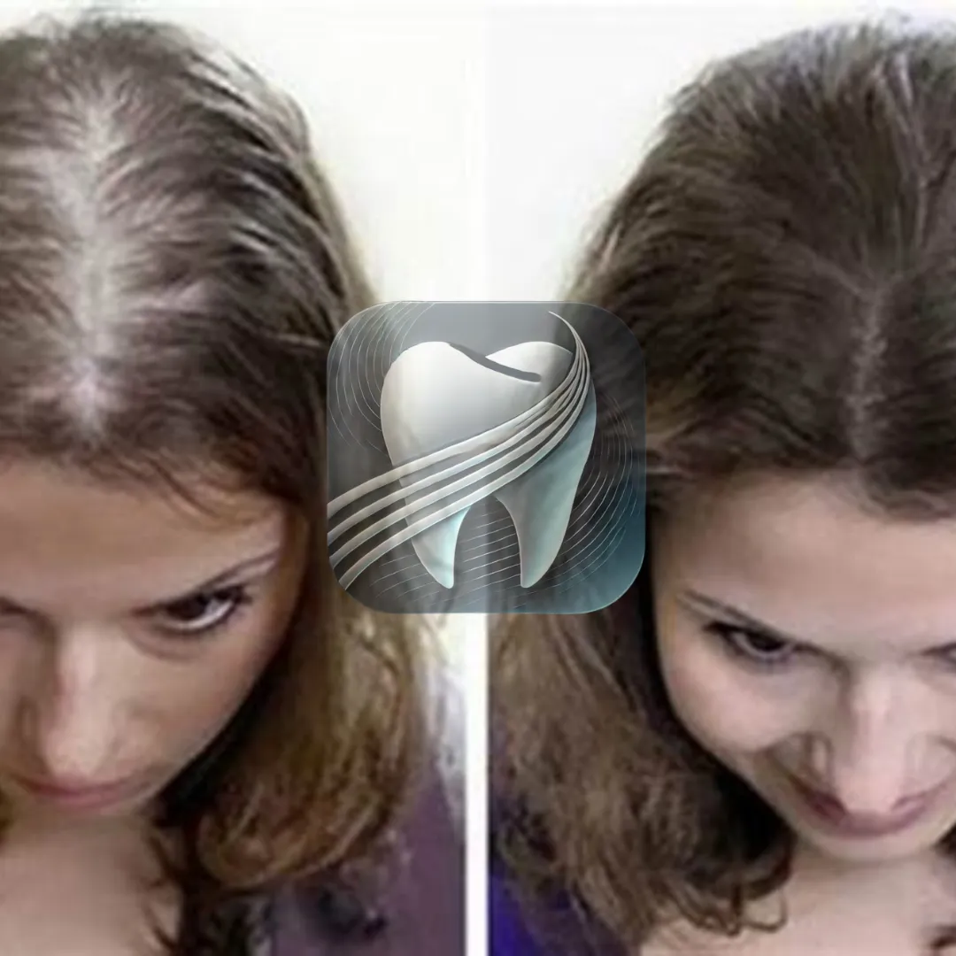 Avant/après greffe de cheveux femme — patiente Elybe Clinic, Turquie