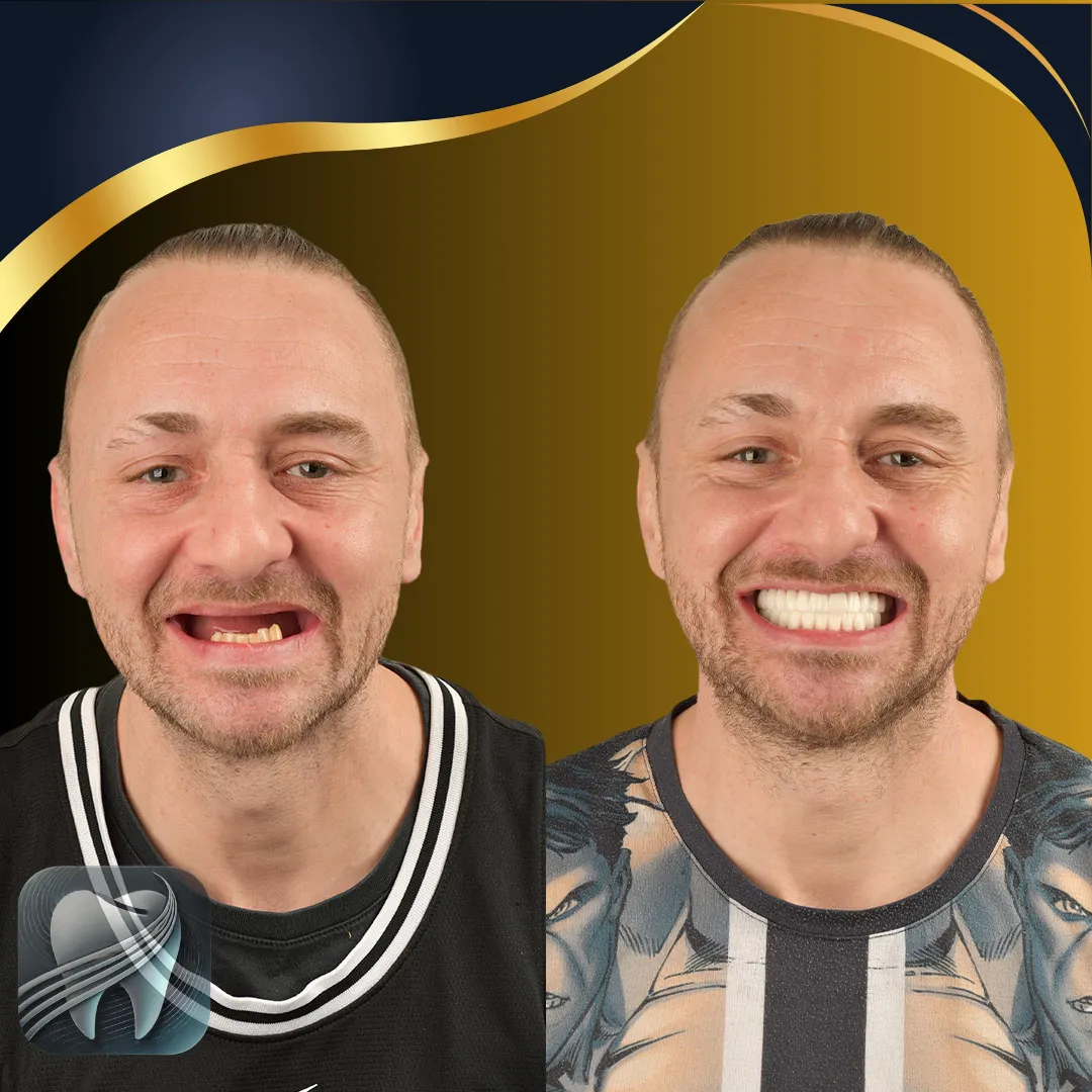 Avant/après réhabilitation complète sur implants — patient Elybe Clinic, Turquie