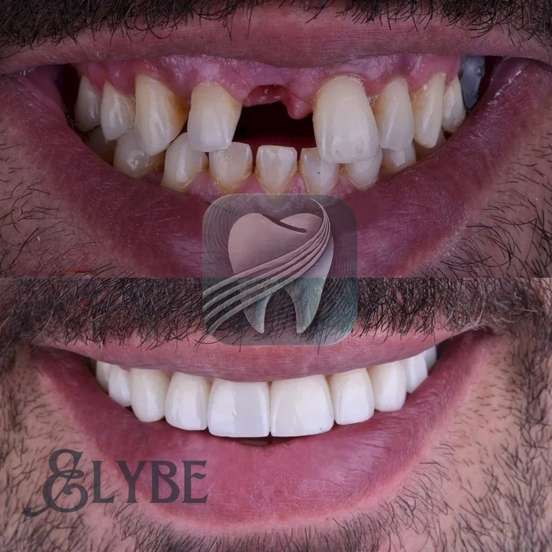 Avant/après remplacement de dents manquantes — patient Elybe Clinic