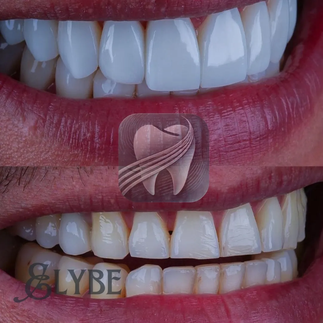Avant/après du sourire en gros plan — patient Elybe Clinic