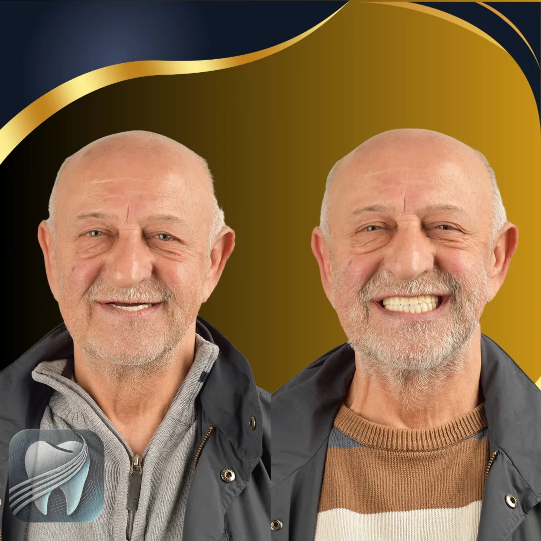 Avant/après transformation du sourire — patient Elybe Clinic, Turquie