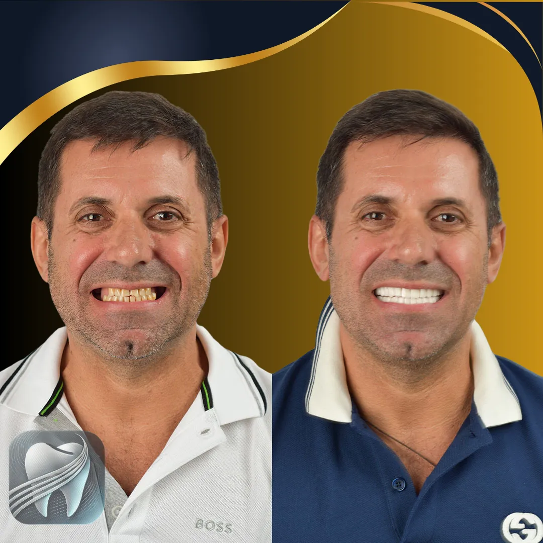 Avant/après transformation du sourire — patient Elybe Clinic, Turquie