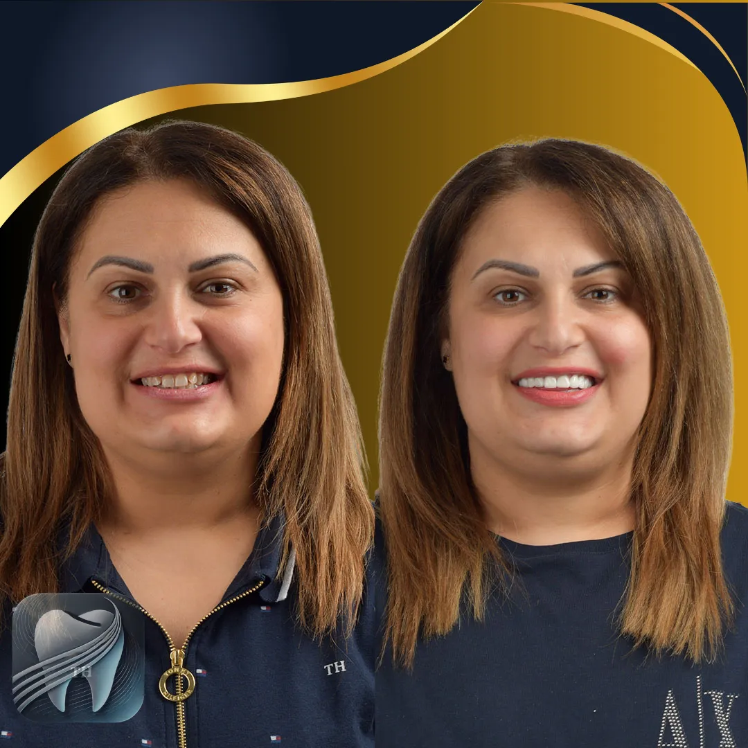 Avant/après transformation du sourire — patient Elybe Clinic, Turquie