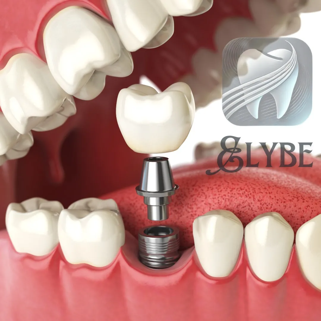 Illustration 3D d'un implant dentaire et de sa couronne