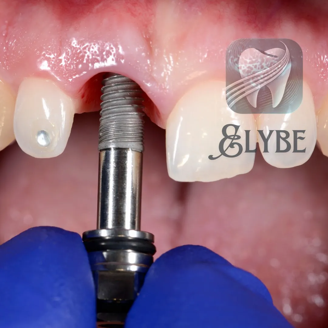 Pose d'un implant dentaire en clinique — Elybe Clinic